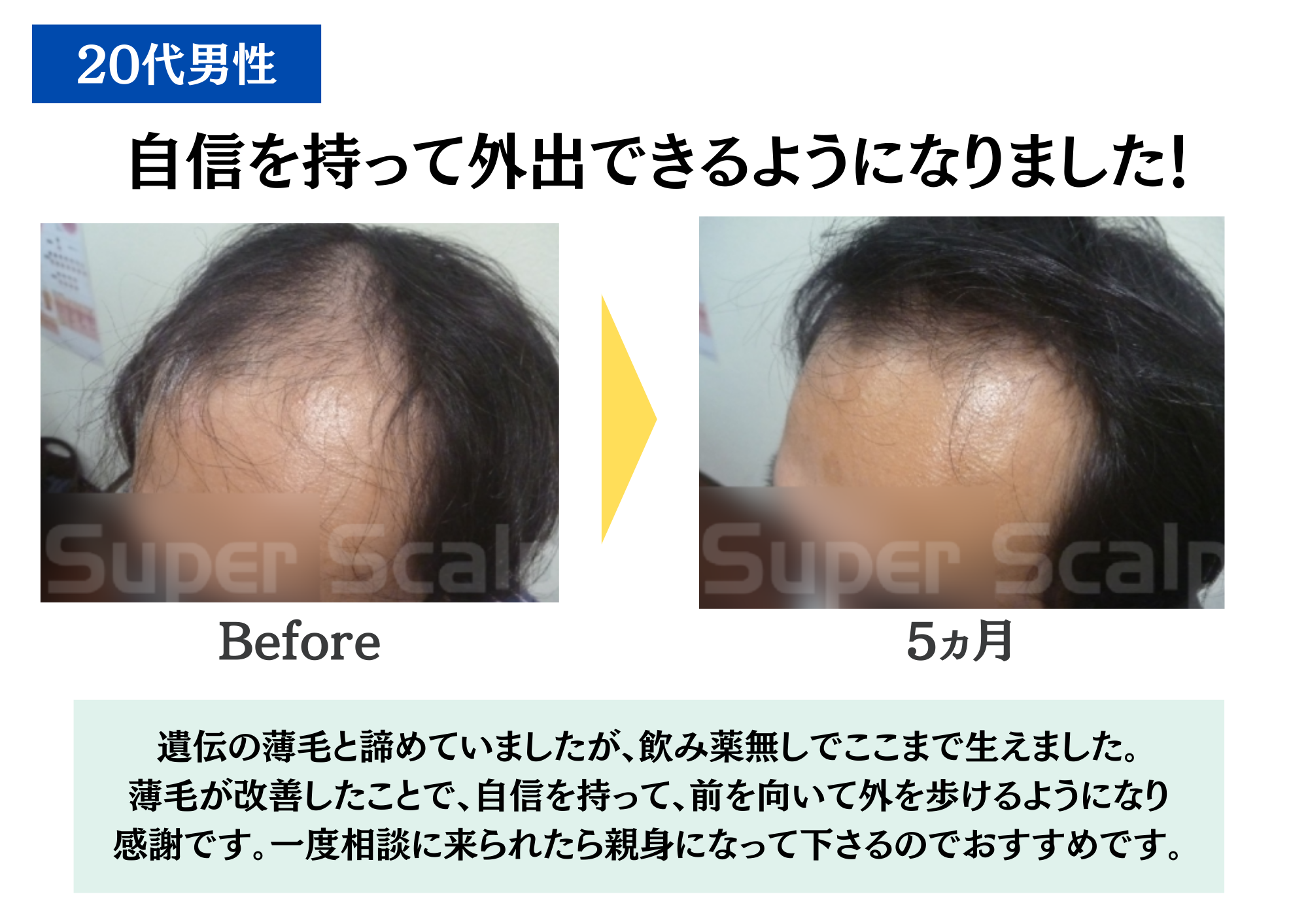 20代男性M字ハゲのAGAや薄毛の改善効果による育毛発毛