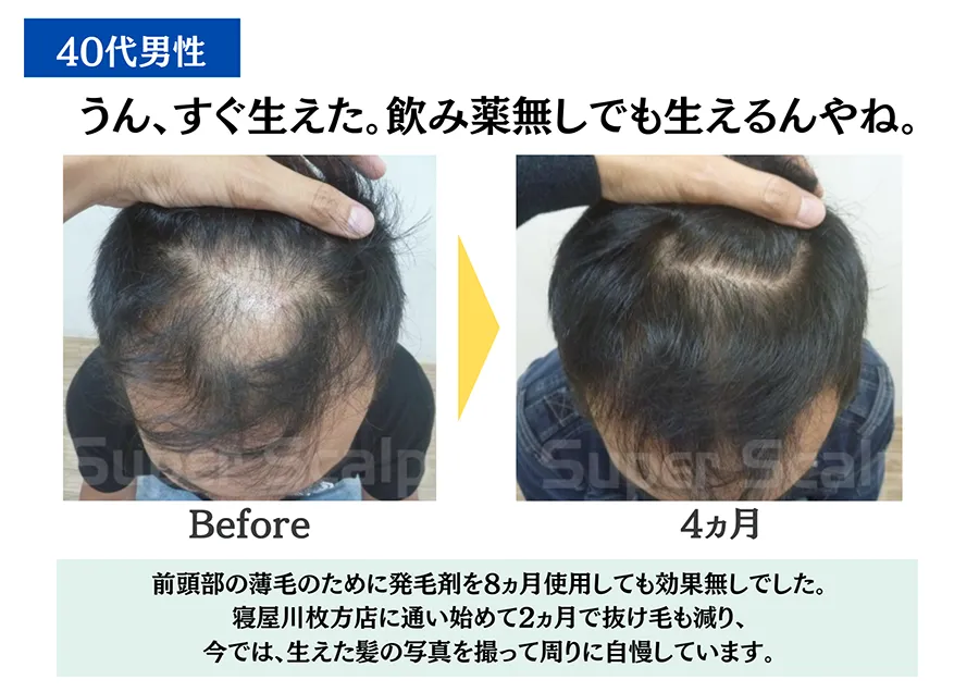 40代男性の生え際薄毛の改善効果による育毛発毛