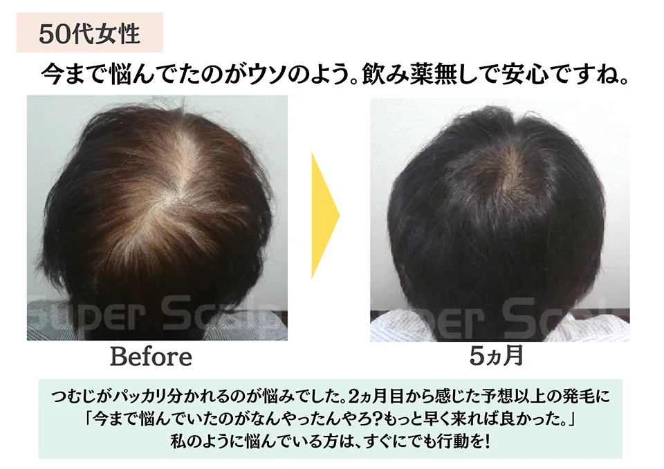 50代女性のつむじハゲの薄毛の改善効果による育毛発毛