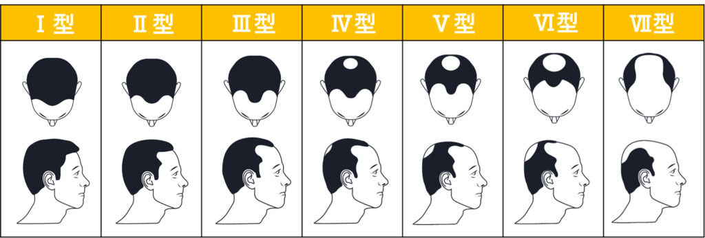 Agaの特徴とは 薄毛男性の90 が悩むagaの正体 公式 スーパースカルプ発毛センター寝屋川枚方店