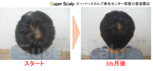 20代AGA症例2