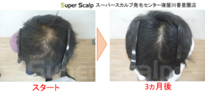 20代AGA症例1