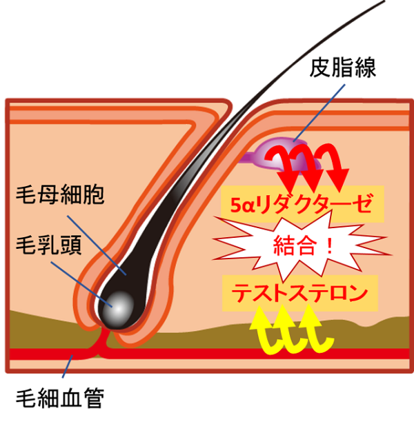 AGAの特徴原因解説図1