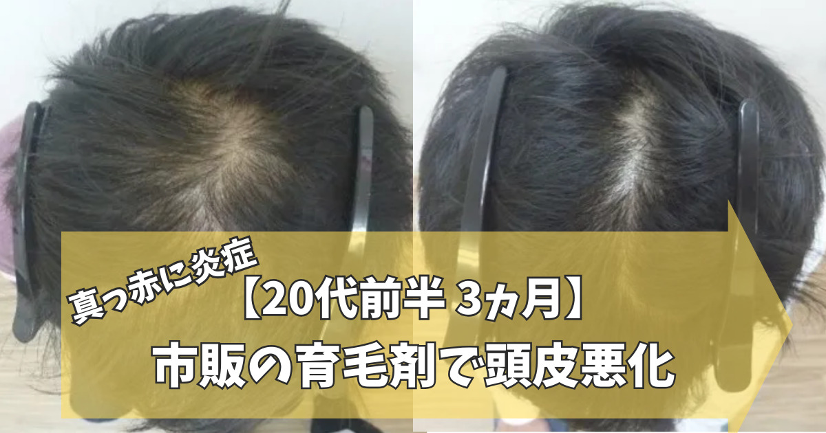 20代男性】市販の育毛剤で荒れ果てた頭皮を3ヶ月でスピード発毛 