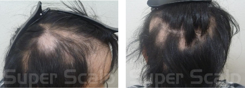 多発性円形脱毛症の30代男性発毛実績0ヵ月