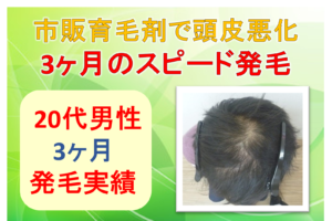 20代薄毛
