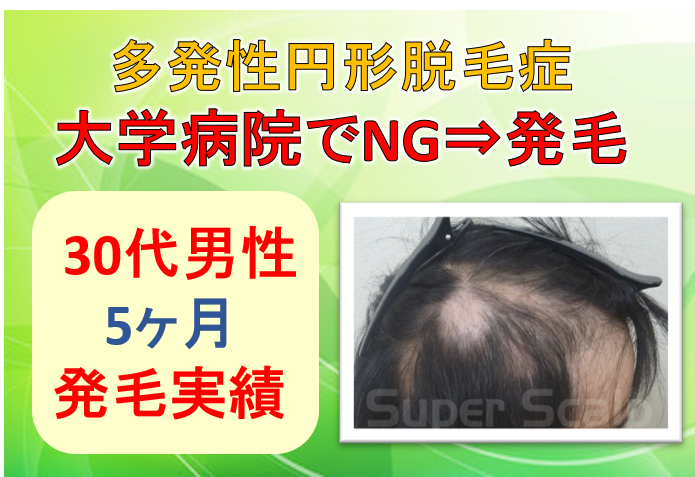 30代男性 大学病院ngの多発性円形脱毛症を5ヶ月で発毛へ 公式 スーパースカルプ発毛センター寝屋川枚方店