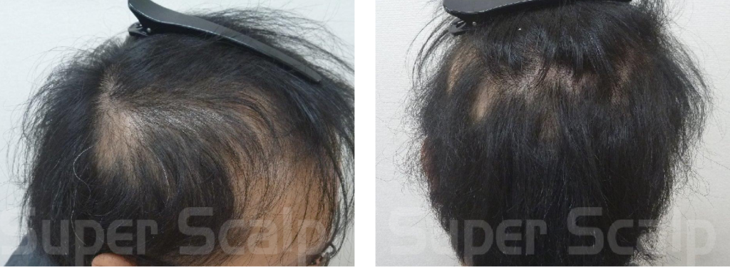 多発性円形脱毛症の30代男性発毛実績3ヵ月