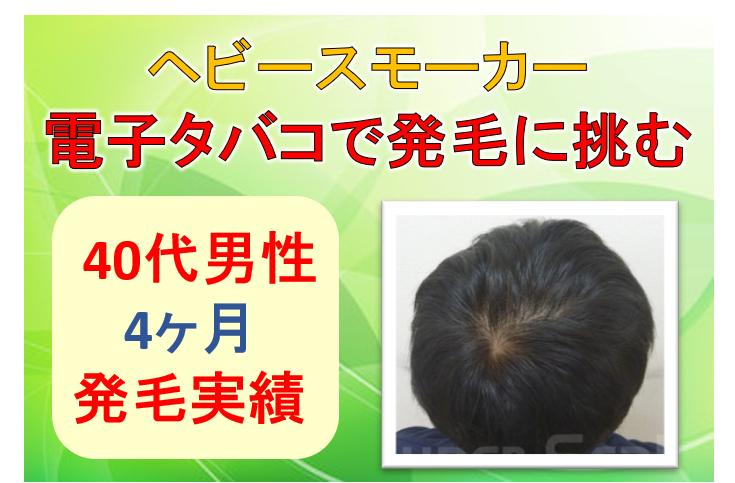 40代男性 ヘビースモーカーがつむじの発毛に挑む 公式 スーパースカルプ発毛センター寝屋川枚方店