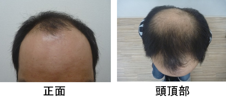 発毛症例30代男性 1