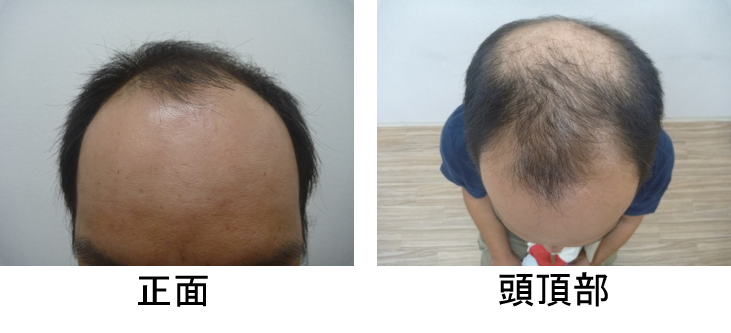 発毛症例30代男性 2