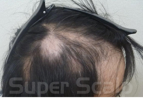 円形発毛症例30代男性 1