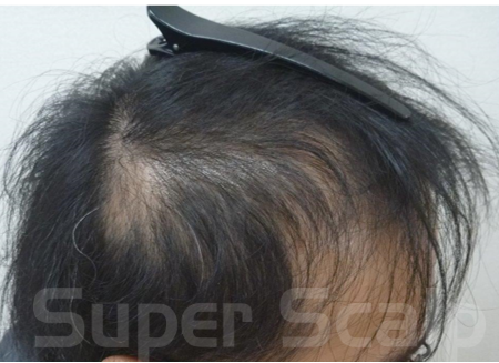 円形発毛症例30代男性 4