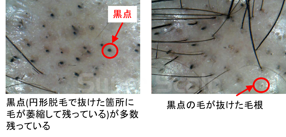 円形脱毛症後の白髪の理由と対処法 画像解説付き 公式 スーパースカルプ発毛センター寝屋川枚方店