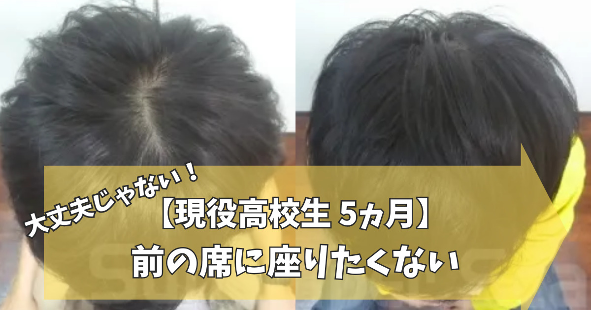 高校生男性】若ハゲの恐怖。親子で頑張り薄毛改善 | 【公式】スーパー 