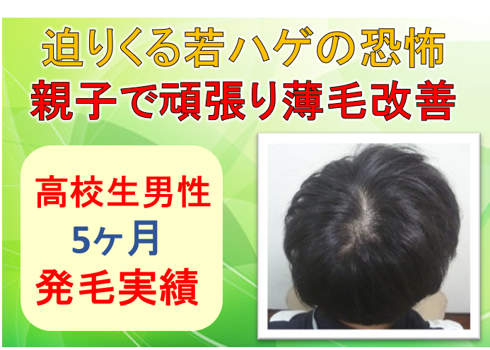 高校生男性 若ハゲの恐怖 親子で頑張り薄毛改善 公式 スーパースカルプ発毛センター寝屋川枚方店