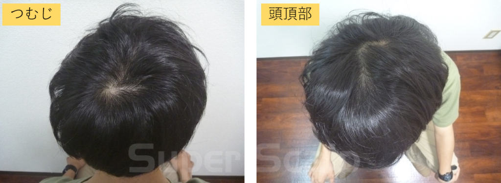 10代男性発毛1ヶ月
