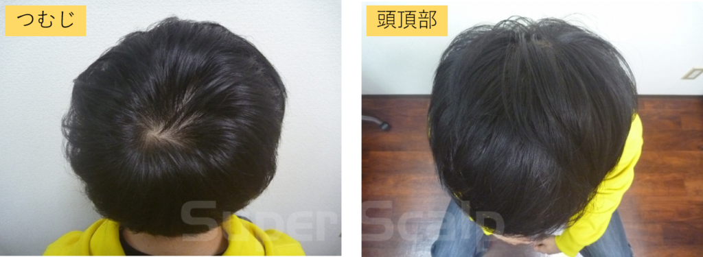 10代男性発毛5ヶ月