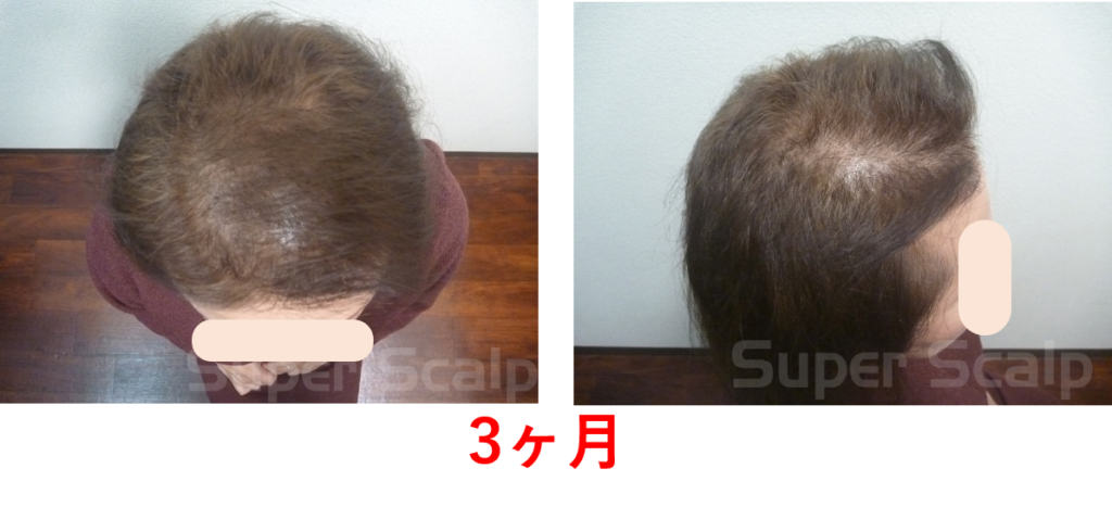 発毛3ヶ月