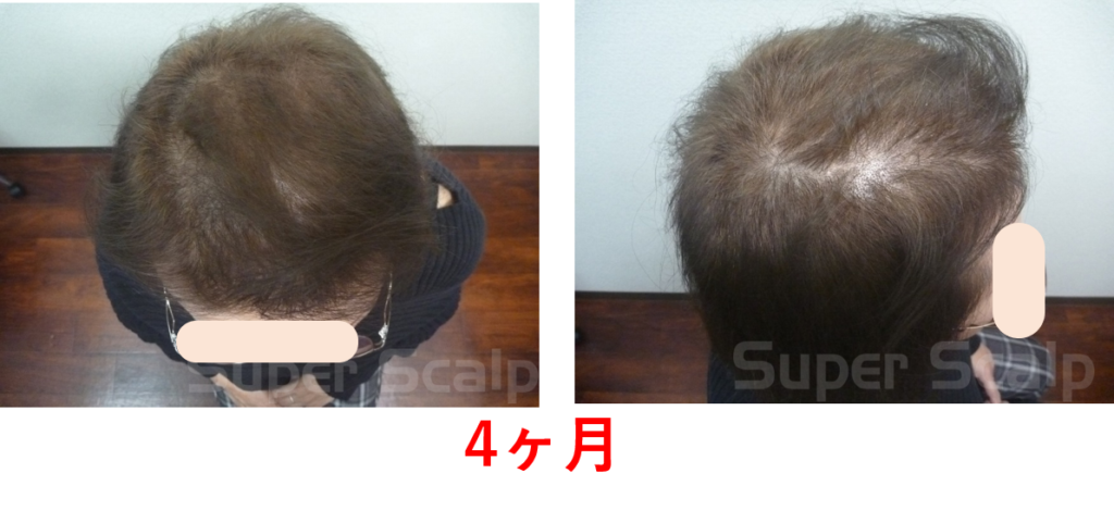 発毛4ヶ月50代女性