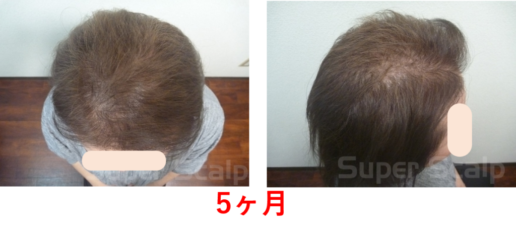 発毛5ヶ月50代女性