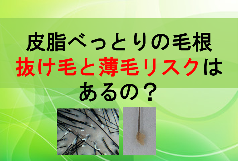 皮脂べったり毛根 抜け毛と薄毛リスクはある 公式 スーパースカルプ発毛センター寝屋川枚方店