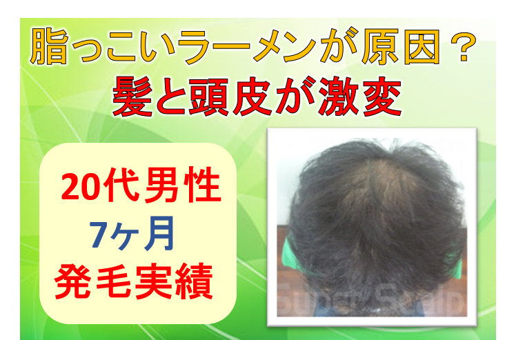 代男性 原因はラーメン 食を変えて髪と頭皮が激変 公式 スーパースカルプ発毛センター寝屋川枚方店