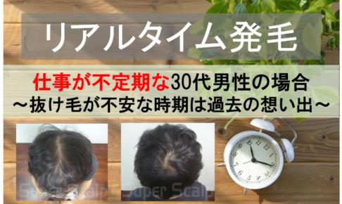 30代男性の発毛