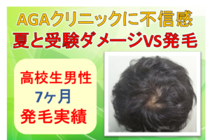 高校生男性 若ハゲの恐怖 親子で頑張り薄毛改善 公式 スーパースカルプ発毛センター寝屋川枚方店