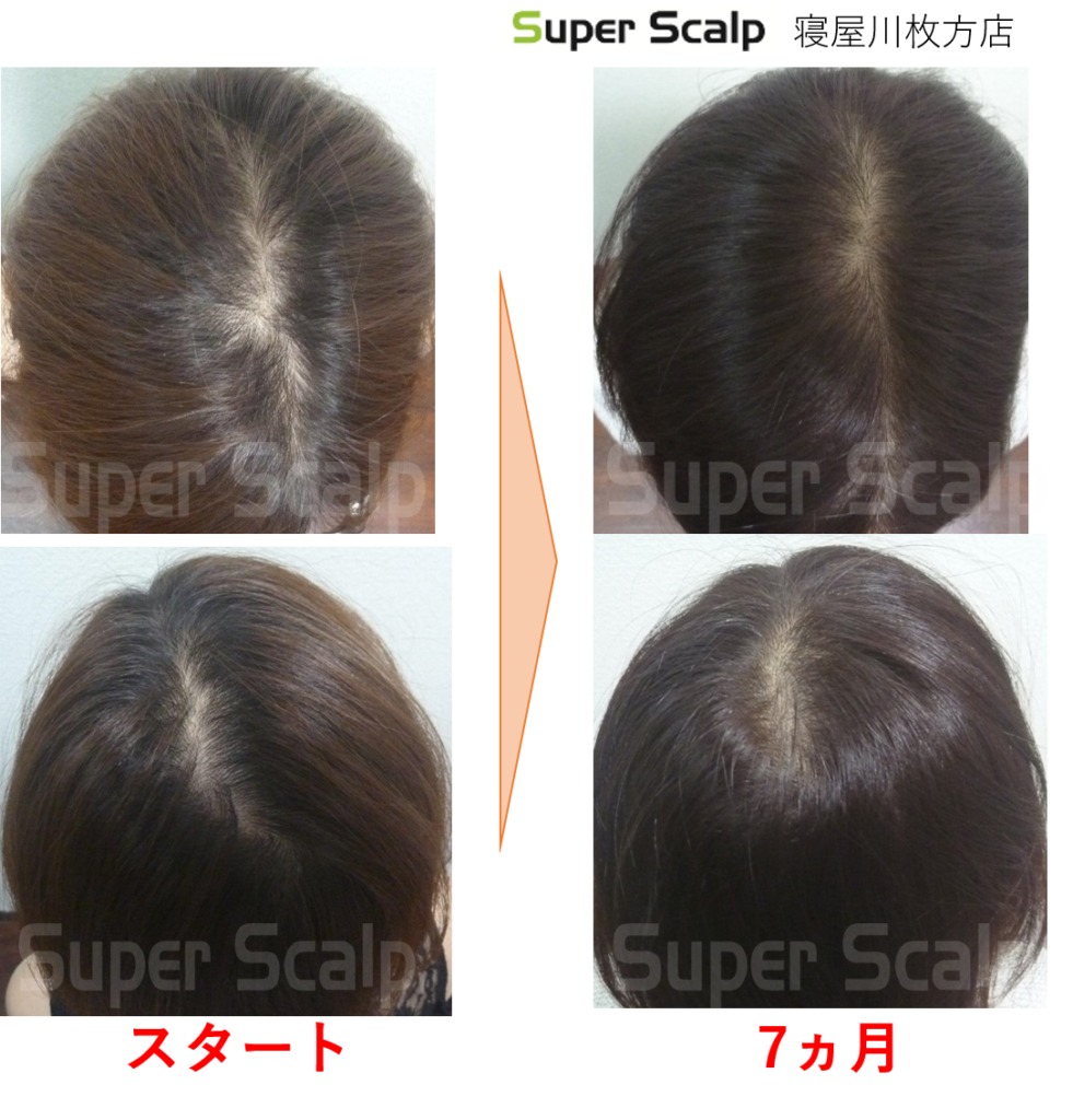 30代女性 漢方をすすめる皮膚科に疑問 施術回で分け目の薄毛を克服 公式 スーパースカルプ発毛センター寝屋川枚方店