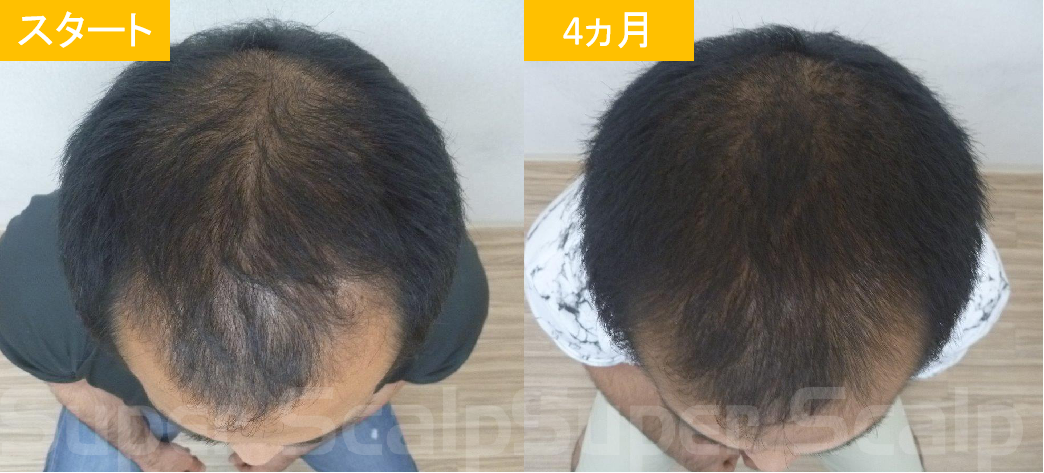 30代男性発毛症例9