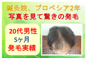 20代男性の発毛実績