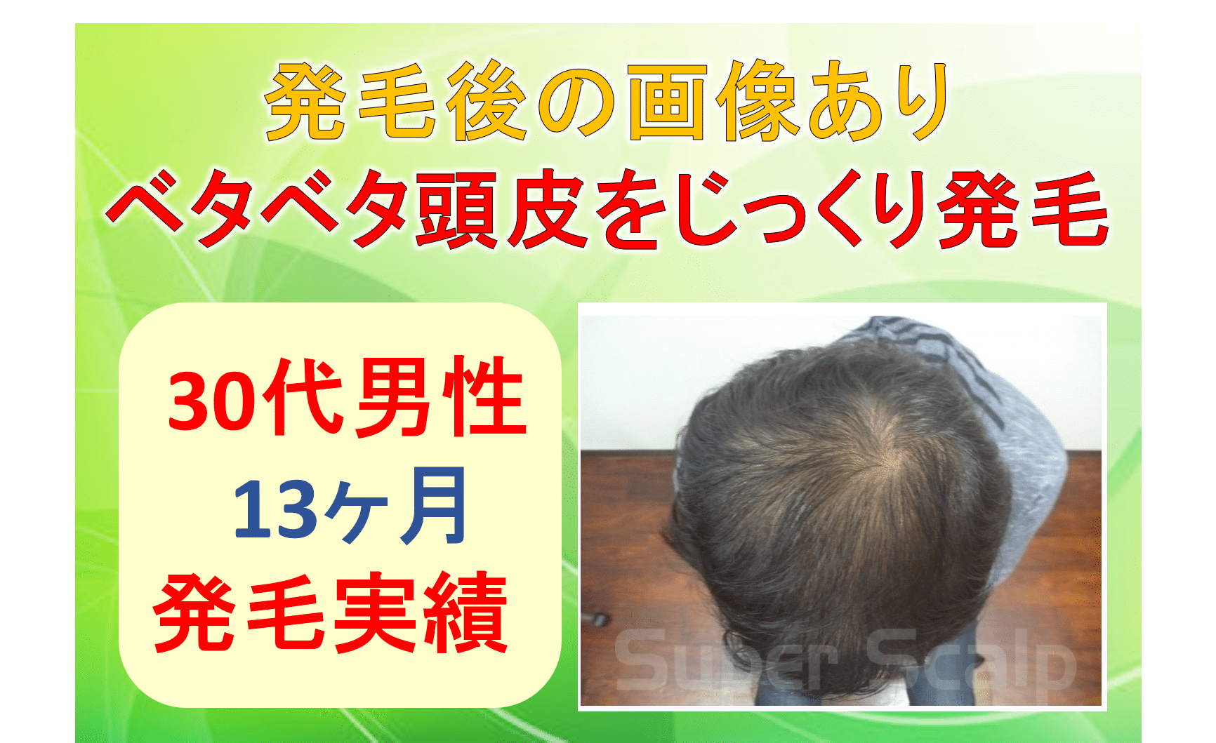 30代男性の発毛