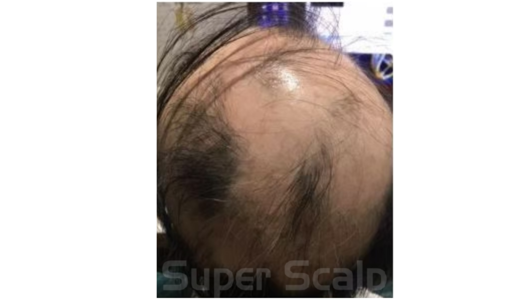【円形脱毛症】40代女性発毛実績0ヵ月