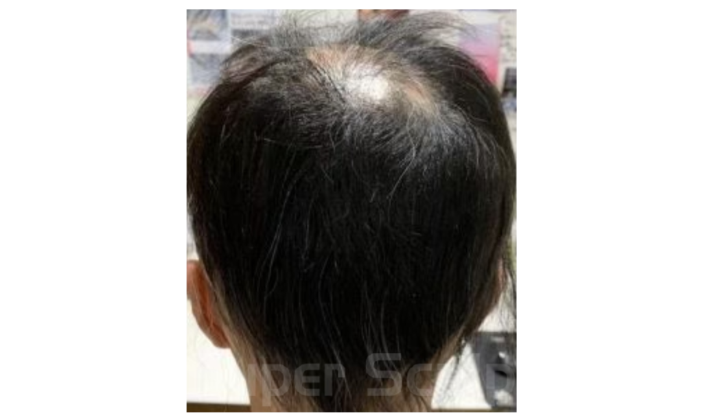 【円形脱毛症】40代女性発毛実績5ヵ月