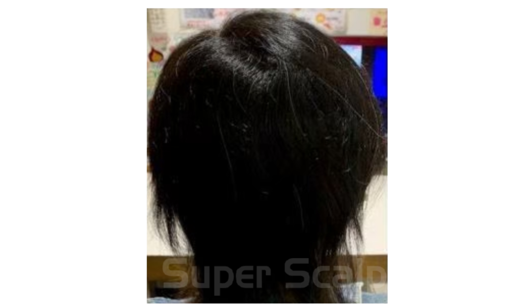【円形脱毛症】40代女性発毛実績12ヵ月