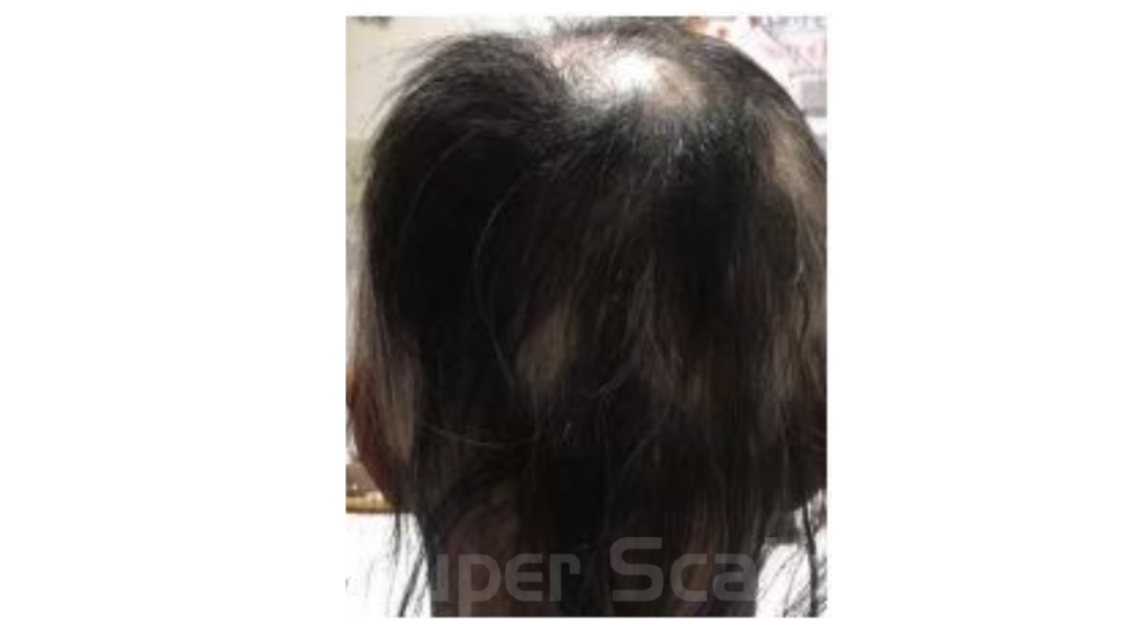 【円形脱毛症】40代女性発毛実績3ヵ月