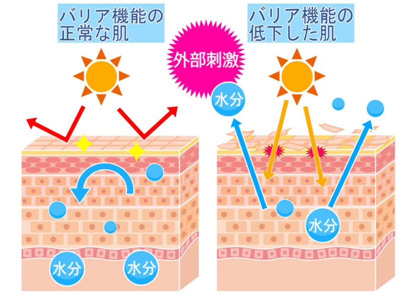 脂漏性皮膚炎は日焼けに注意