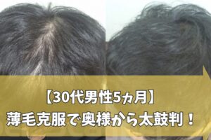 30代男性の5カ月の前頭部薄毛改善