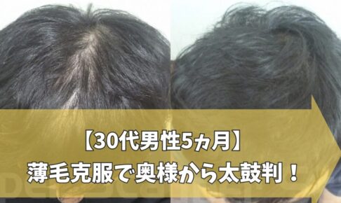 30代男性の5カ月の前頭部薄毛改善