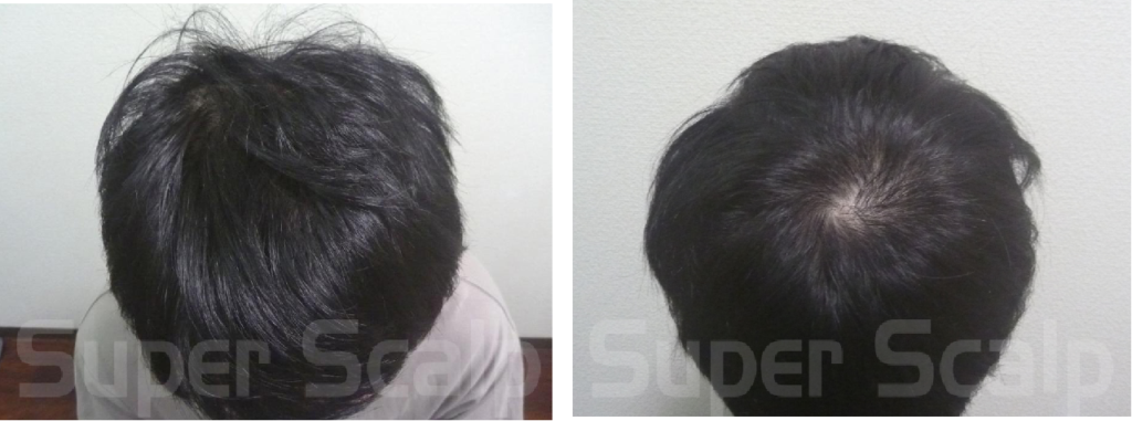 30代男性発毛実績4ヵ月