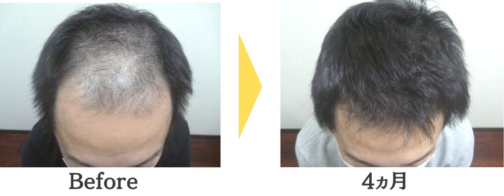 40代男性の頭部を2枚の画像でビフォーアフター