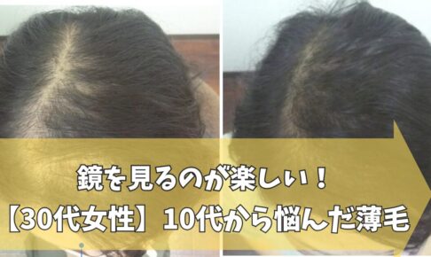 30代女性の薄毛改善