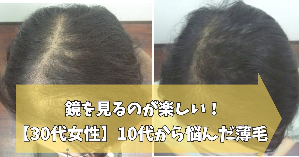 30代女性の薄毛改善