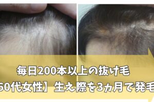 60代女性の生え際の発毛