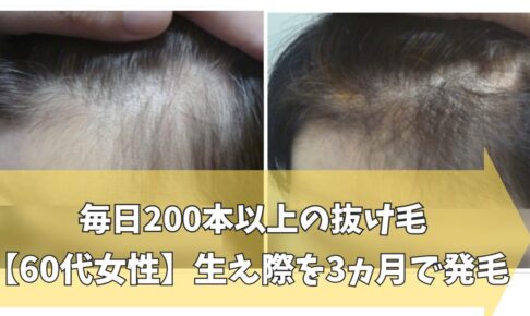 60代女性の生え際の発毛