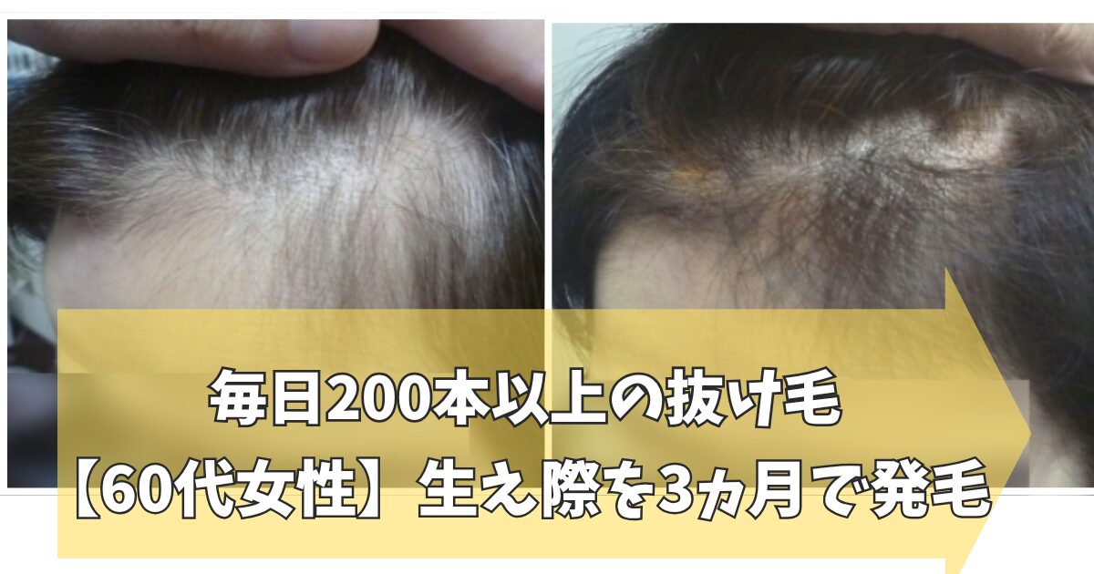 60代女性の生え際の発毛