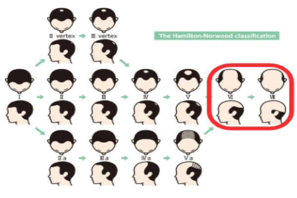 失敗原因3：AGAの進行スピードに追いついていない