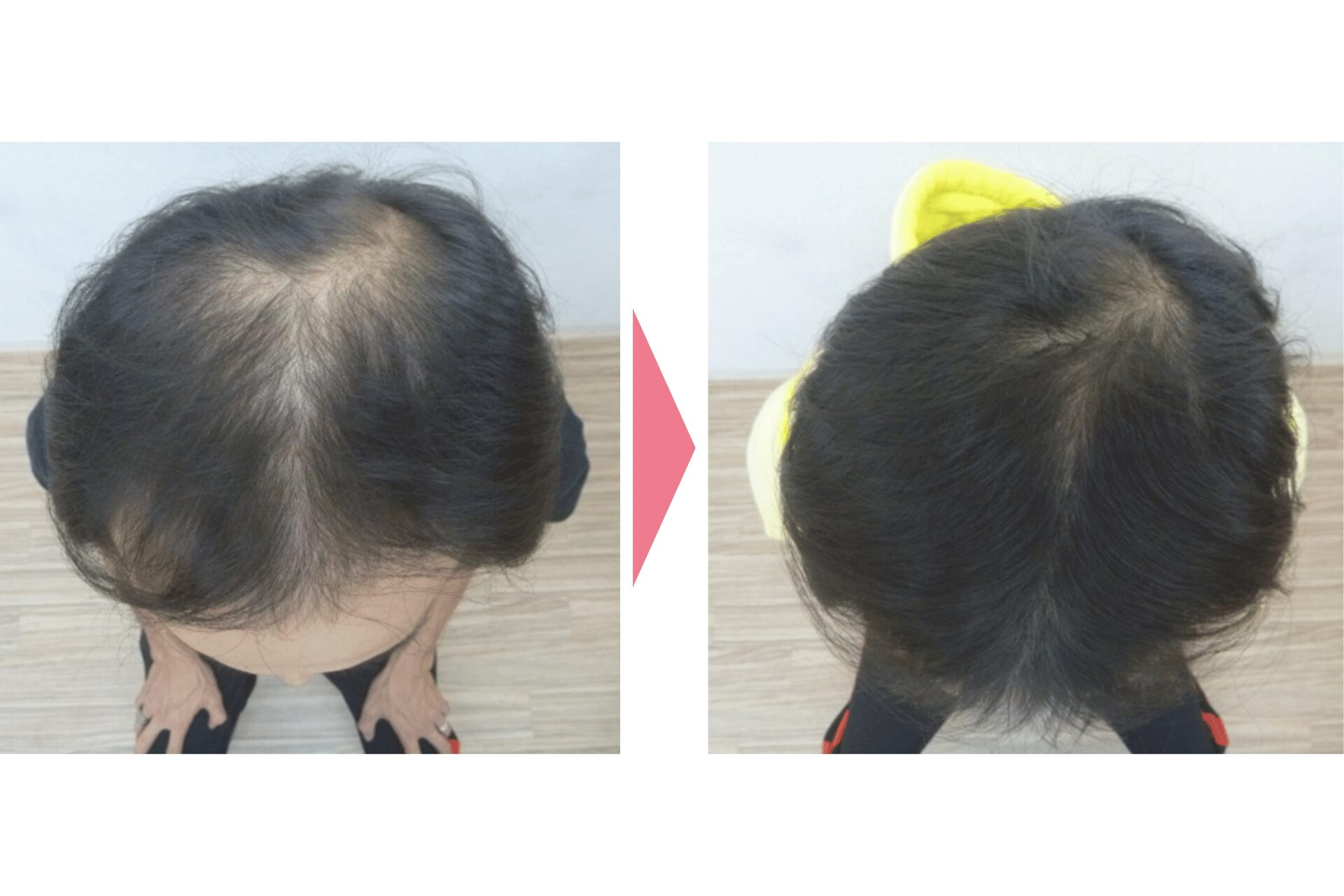 ミノタブをやめて薄くなった40代男性の症例